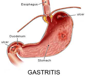 can pepcid cause gastritis